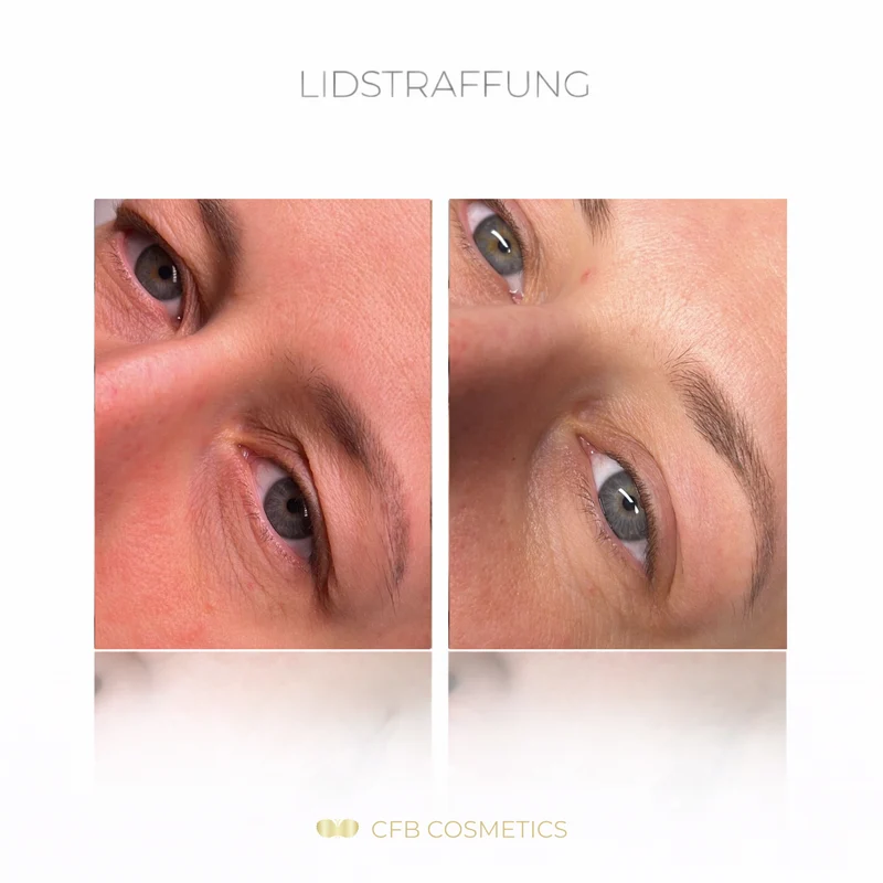 PlasCom® Plasma Pen Gerät für Hautstraffung & Verjüngung CFB Cosmetics®