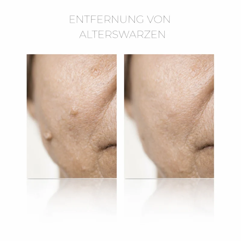 PlasCom® Plasma Pen Gerät für Hautstraffung & Verjüngung CFB Cosmetics®