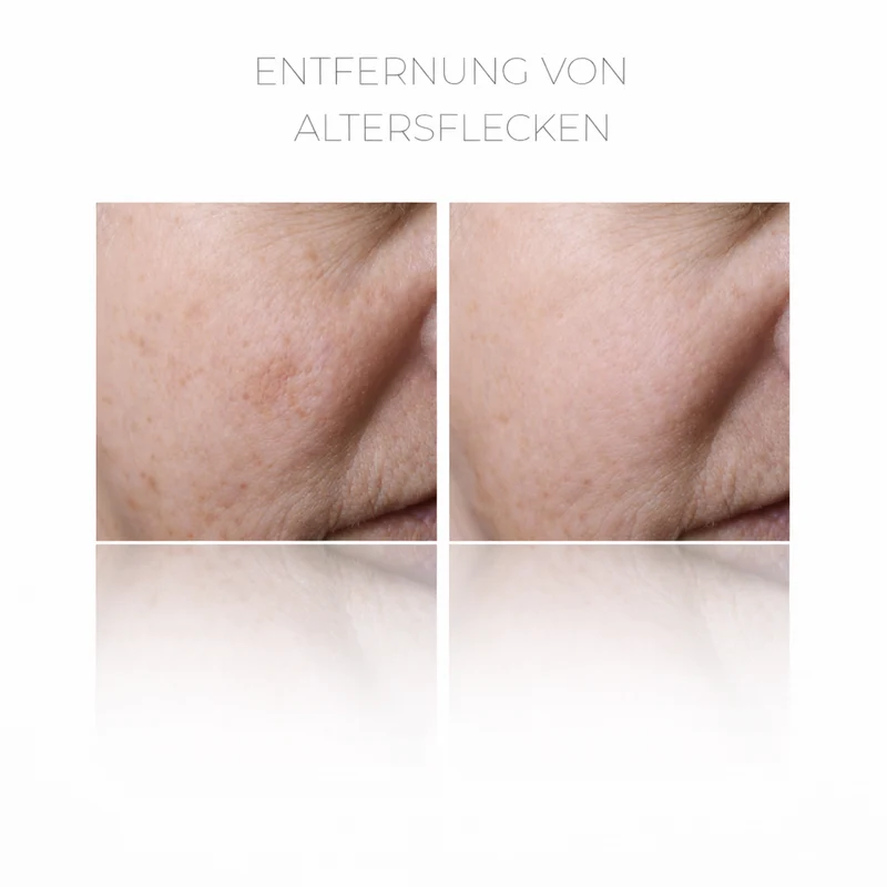 PlasCom® Plasma Pen Gerät für Hautstraffung & Verjüngung CFB Cosmetics®