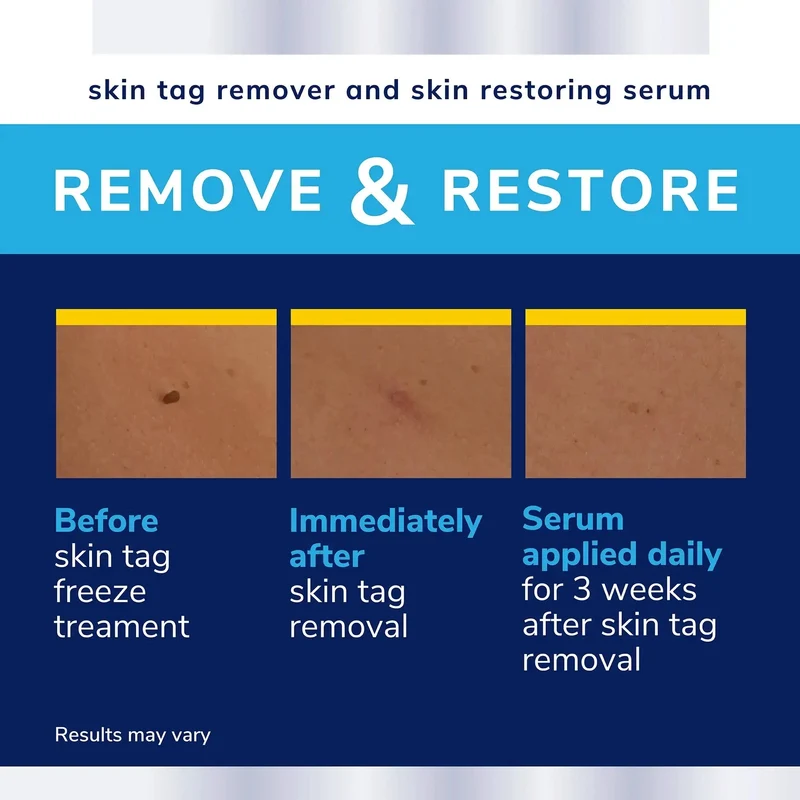 Complete Care Skin Tag Removal Kit