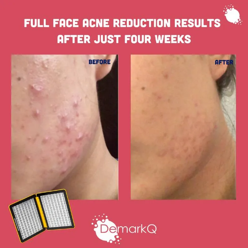 DemarkQ WOW LED Light Full Facial Acne Treatment