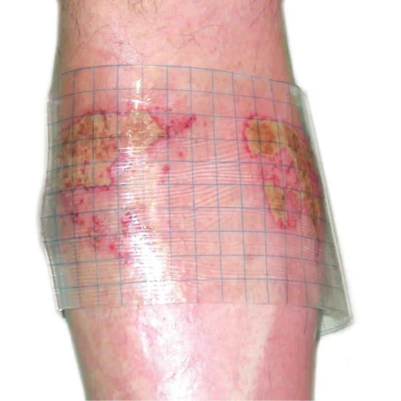 HydroTac transparent Gelverband